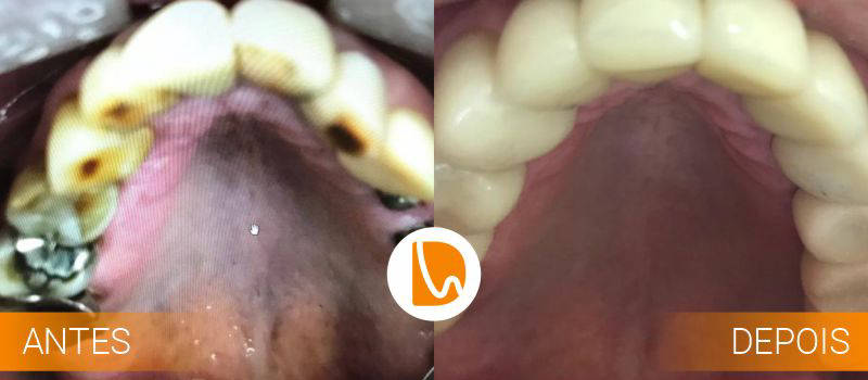 Implante Dentário com Cirirgia Guiada